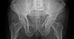 La Nación / La osteoporosis aumenta el riesgo de sufrir fracturas