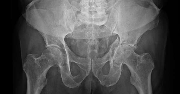 La Nación / La osteoporosis aumenta el riesgo de sufrir fracturas