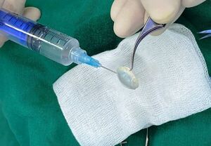 Mal uso de lente de contacto derivó en trasplante de córnea •