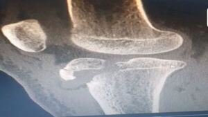 Papá denuncia que docentes no auxiliaron a su hija que se rompió la rodilla
