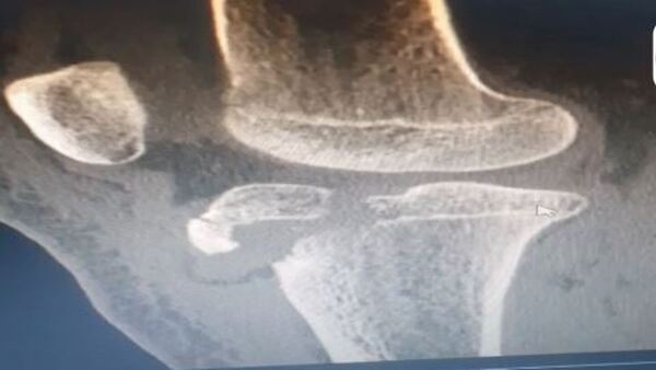 Papá denuncia que docentes no auxiliaron a su hija que se rompió la rodilla