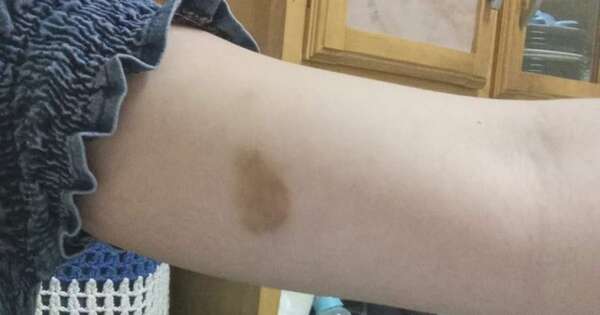 Diario HOY | Despechado molió a golpes a su exnovia por no aceptar el fin de la relación
