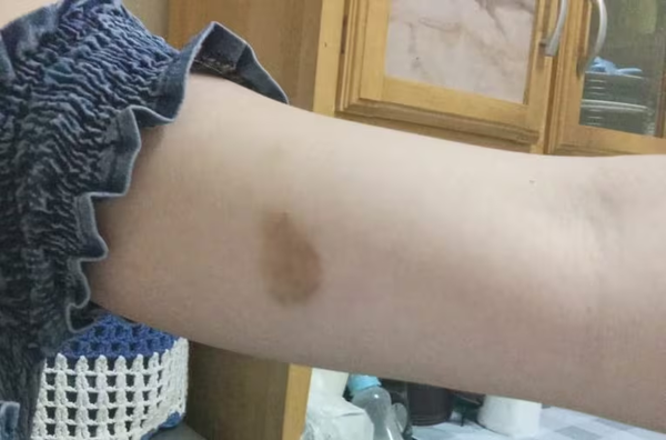 Despechado molió a golpes a su exnovia por no aceptar el fin de la relación - Noticiero Paraguay