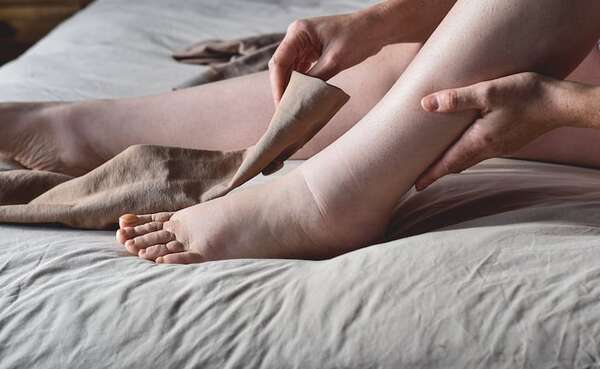 Lipedema y linfedema en una charla para pacientes - Nacionales - ABC Color