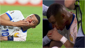 Versus / Kylian Mbappé sufre una fractura en la nariz
