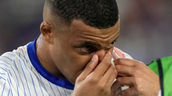 ¡Escalofriante! Así quedó la nariz de Kylian Mbappé en el Austra vs Francia