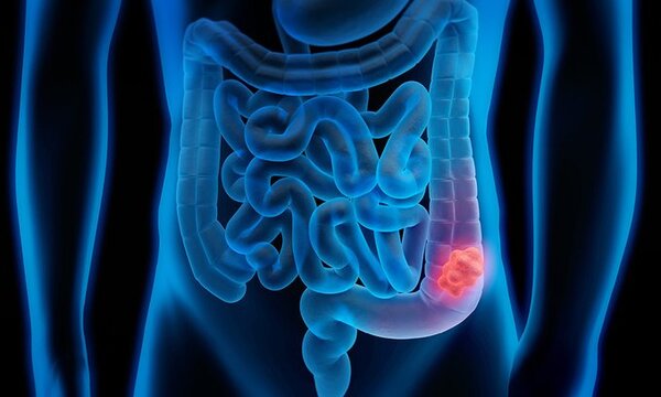 El cáncer colorrectal es el segundo más común, luego del cáncer de mama y próstata, afirma profesional