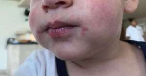 Diario HOY | Enfermedad de boca, manos y pies en niños: Clínicas reporta aumento de consultas