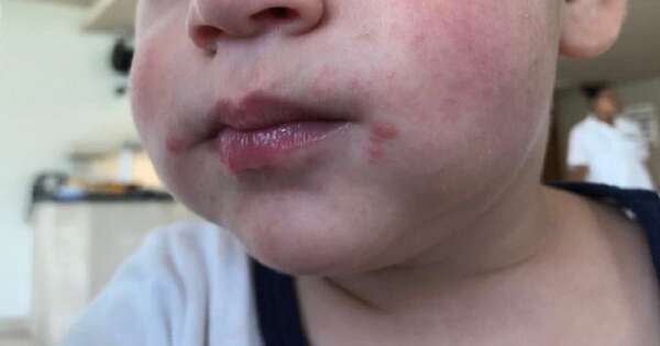 Diario HOY | Enfermedad de boca, manos y pies en niños: Clínicas reporta aumento de consultas