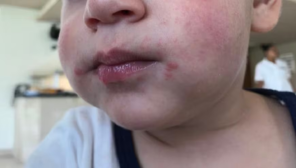 Enfermedad de boca, manos y pies en niños: Clínicas reporta aumento de consultas