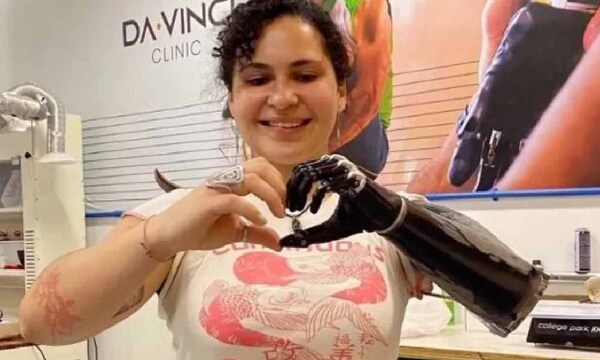 Renata ya está probando su prótesis – Prensa 5