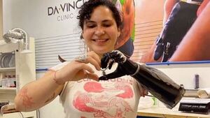 Renata ya está probando su prótesis