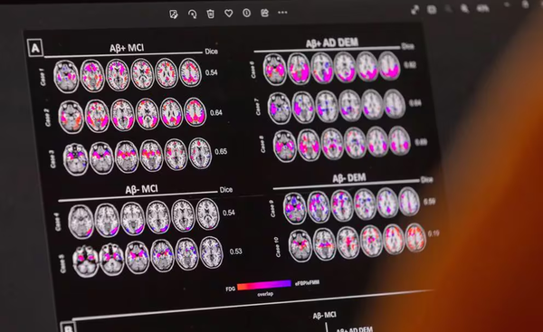 La FDA aprobó un fármaco que retrasa el avance del Alzheimer - Megacadena - Diario Digital
