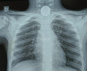 Médicos del Ineram asisten a niños que tragó una moneda de G. 1.000 - ADN Digital