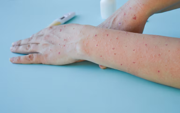 La OMS advierte sobre el virus del mpox, “una amenaza sanitaria mundial”