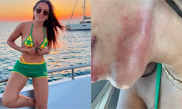 [GALERÍA] ¡La cantante Anitta fue atacada por una medusa y mirá cómo quedó!