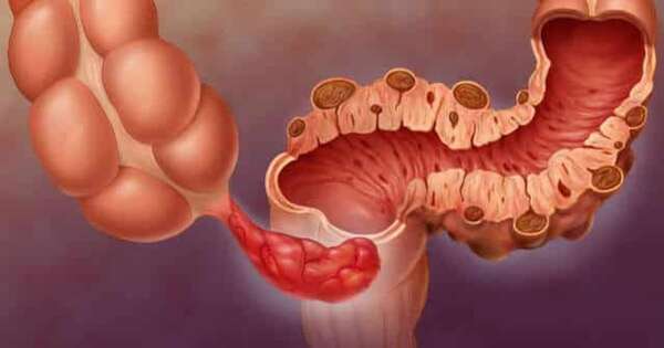 La Nación / El 40 % de la población mayor de 50 años tiene divertículos en el colon, revelan