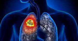 La Nación / El cáncer de pulmón no microcítico aumentó un 16 % en los últimos 5 años, según estudio