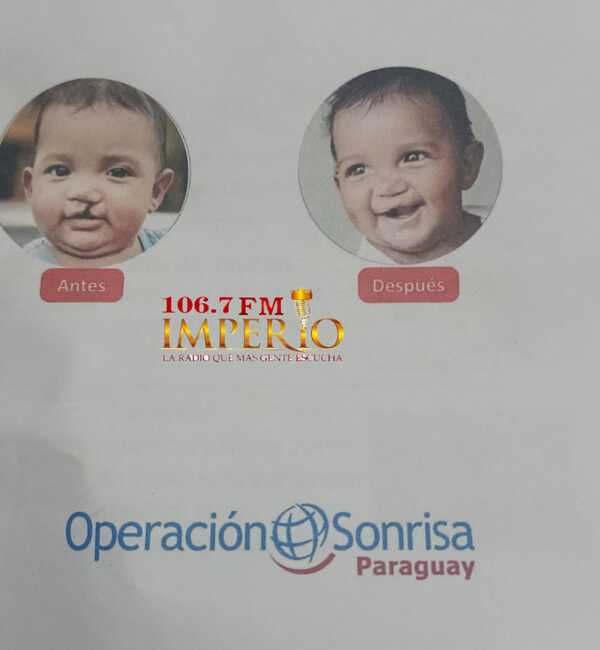 Exitosa cirugía a niño indígena con labio leporino