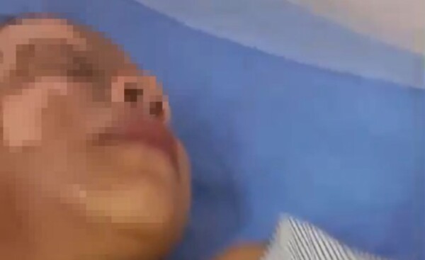 Derraman aguarrás y prenden fuego en el rostro a un niño de 8 años
