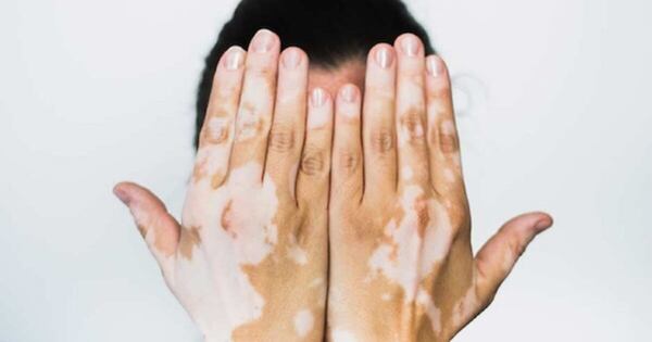 Diario HOY | Vitiligo, un trastorno de la piel que puede ser tratado