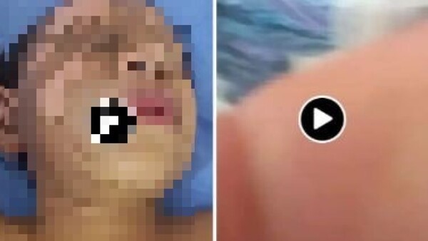 Niño al que le quemaron la cara podría necesitar injerto de piel