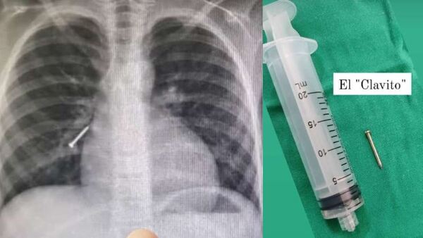 Nene aspiró un clavito y fue a parar en su pulmón
