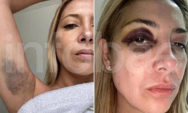 ¡Qué horror! ¡Aparecieron fotos de ex primera dama argentina reventada a golpes!