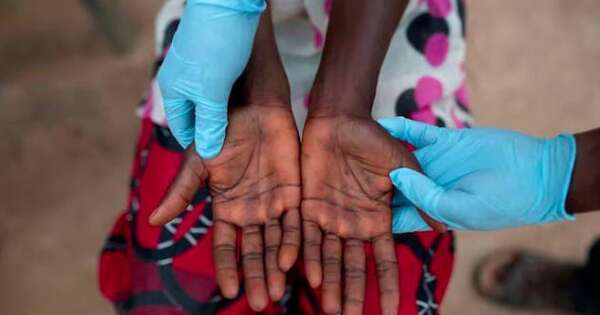Diario HOY | Viruela del mono: declaran “urgencia” sanitaria por epidemia de mpox en África