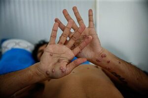 La OMS declaró la emergencia médica mundial por el brote de viruela del mono en África - ADN Digital