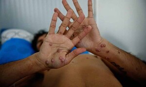 La OMS declaró la emergencia médica mundial por el brote de viruela del mono en África – Prensa 5