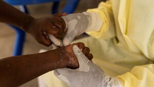 OMS declara emergencia mundial por brote de Viruela del Mono en África