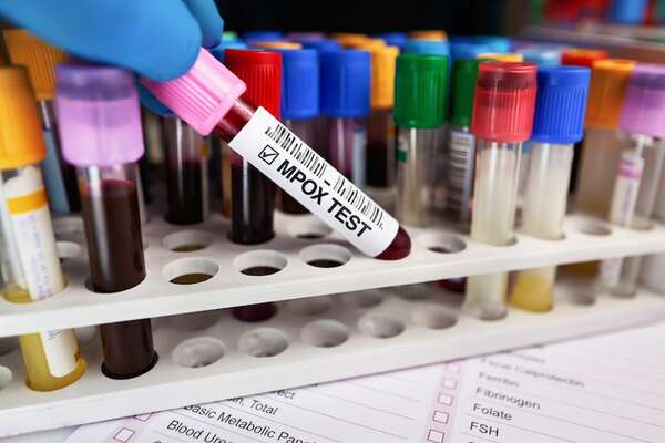 La epidemia de Mpox en cinco claves - Mundo - ABC Color