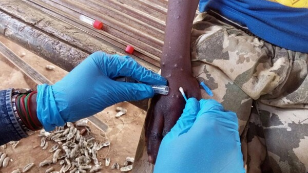 Alerta mundial por viruela del mono: ¿existen casos en el país? síntomas y tratamiento