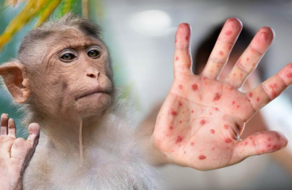 Emergencia global por viruela mpox declara la OMS - Portal Digital Cáritas Universidad Católica