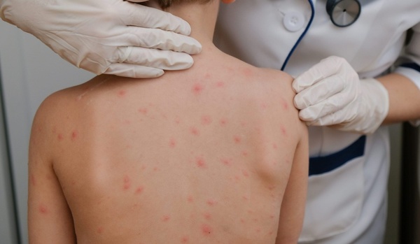 Crecen alertas ante posible expansión del virus del mpox, conocido también como viruela del mono