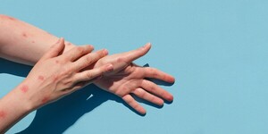 Advierten sobra prevención contra viruela símica
