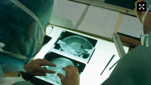 Parkinson: nuevo marcapasos cerebral reduce los síntomas