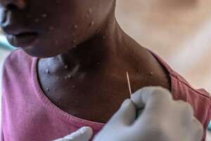 OMS intenta transmitir tranquilidad ante brote de mpox en Africa y un único caso en Europa - Mundo - ABC Color