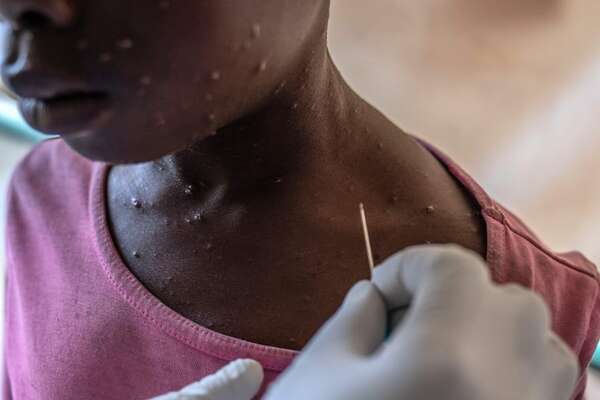 OMS intenta transmitir tranquilidad ante brote de mpox en Africa y un único caso en Europa - Mundo - ABC Color