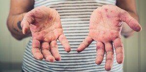 Hasta la fecha, no se registran casos de viruela símica en el país - Unicanal