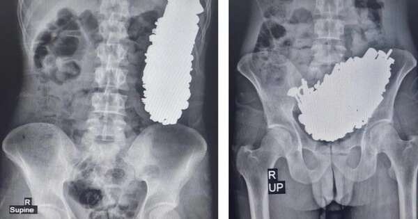 Diario HOY | Extraen del estómago de un hombre 452 objetos metálicos