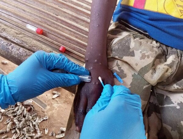 Nueva variante de la viruela del mono podría llegar a Paraguay · Radio Monumental 1080 AM