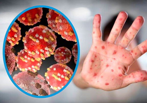 Director de la OMS en Europa: "El mpox no es el nuevo COVID" - ADN Digital