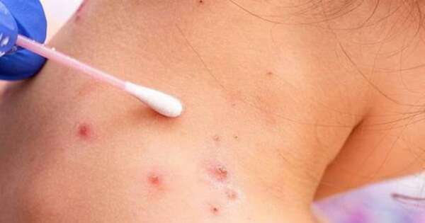 Diario HOY | Un aluvión de informaciones falsas sobre la mpox tras alerta de la OMS