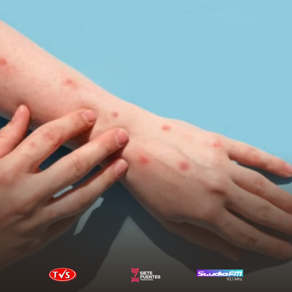 ARGENTINA ANUNCIA PRIMER CASO AUTÓCTONO DE VIRUELA DEL MONO - TVS
