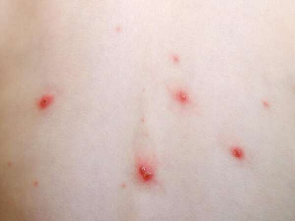 Síntomas de la varicela se parecen a la viruela del mono, advierten