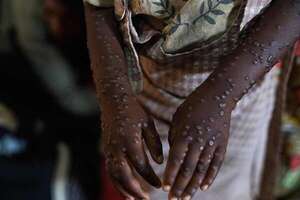 La OMS pide una ayuda de 135 millones de dólares para frenar los brotes de mpox en África - Mundo - ABC Color