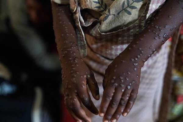 La OMS pide una ayuda de 135 millones de dólares para frenar los brotes de mpox en África - Mundo - ABC Color