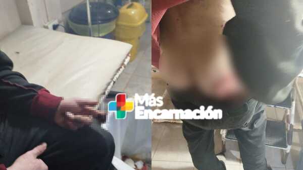 Amputan dedos a internos del CERESO y sospechan de extremas torturas